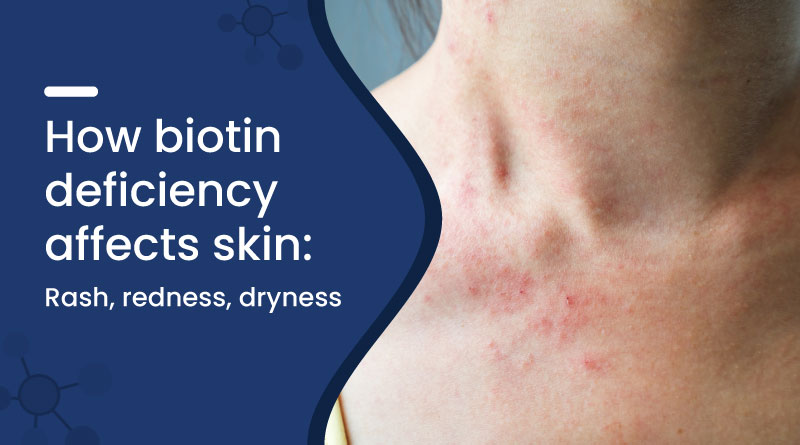 How Biotin Deficiency Affects Skin: Rash, Redness, Dryness