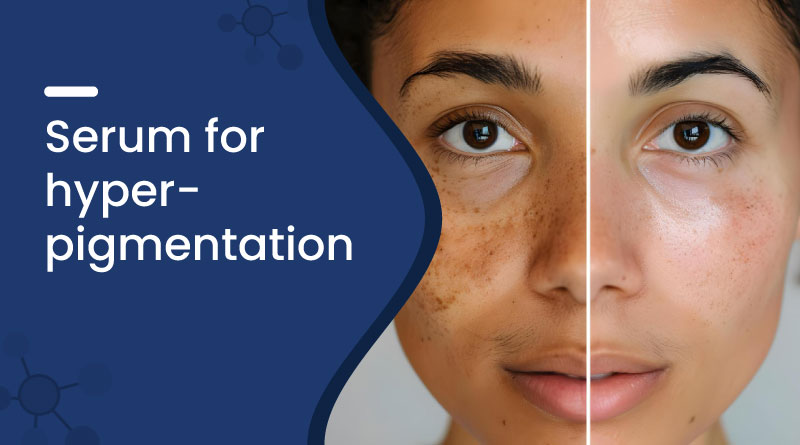 Best Serum for Hyperpigmentation &ndash; Fade Dark Spots Naturally
