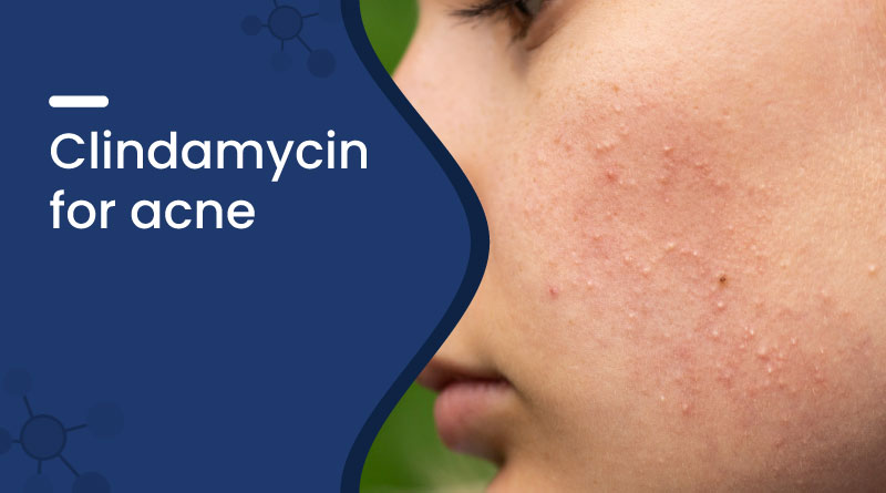 Clindamycin for Acne