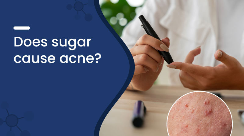 Does Sugar Cause Acne?