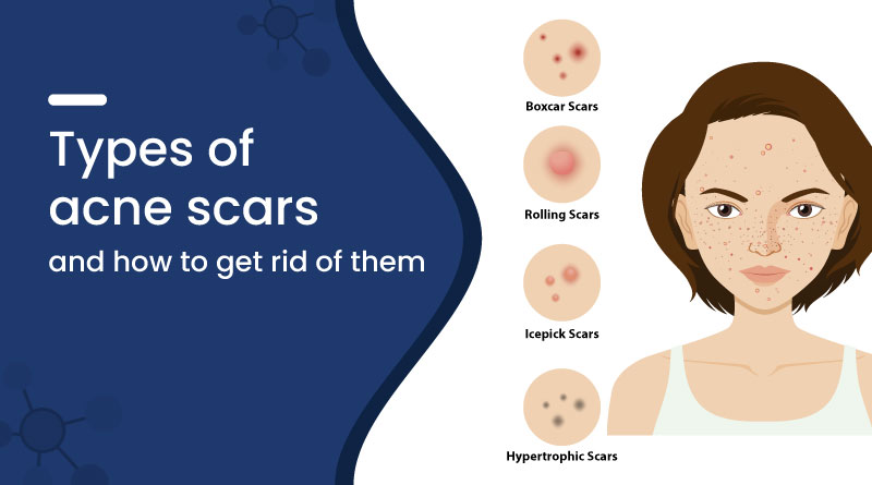 Types of Acne Scars (With Images), and How to Get Rid of Them