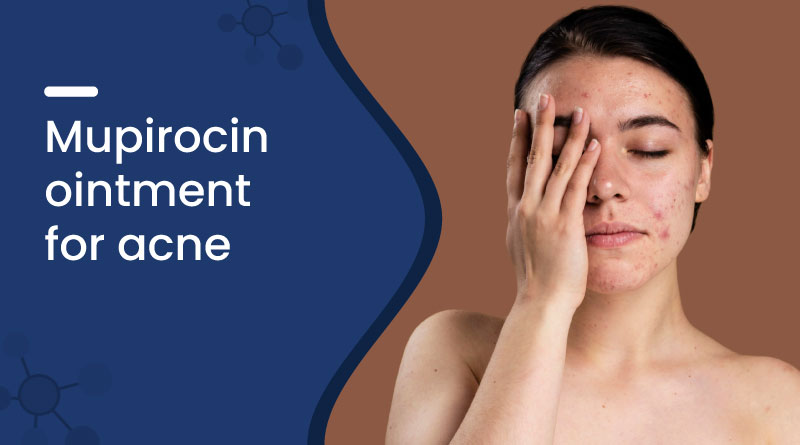 Can Mupirocin Be Used for Acne?