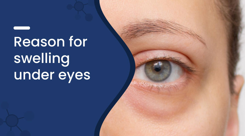 Reasons for Swelling Under Eyes