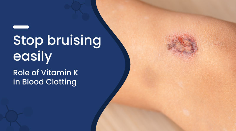 Stop Bruising Easily: How Vitamin K Helps in Blood Clotting