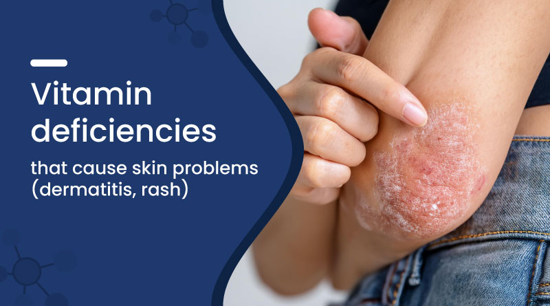 Vitamin Deficiencies That Cause Skin Problems (Dermatitis, Rash)
