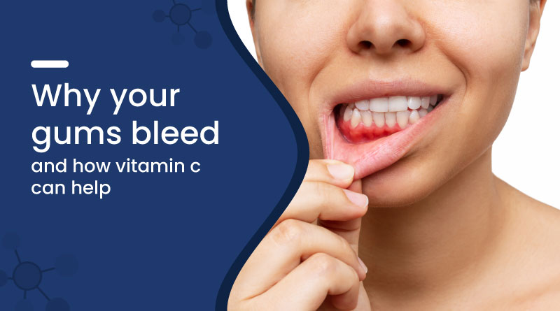 Why Your Gums Bleed and How Vitamin C Can Help