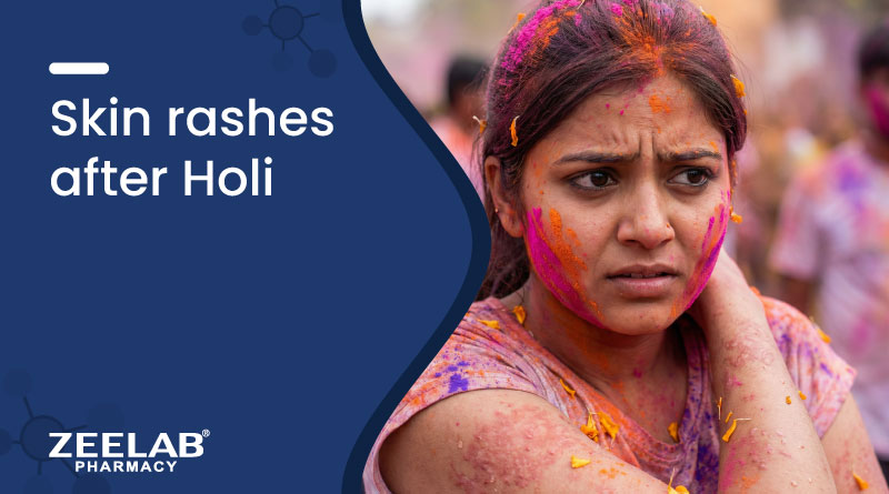 https://zeelabhealth.com/public/uploads/blogs/skin-rashes-after-holi-treatment-causes-medicines.jpg