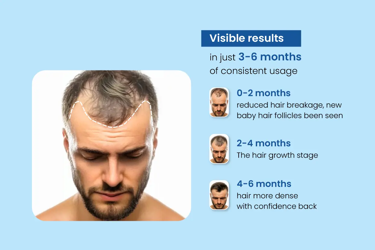 minoxil f 10 hair growth treatment results