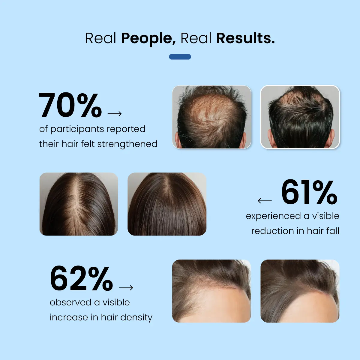 Minoxil F 5% Topical Solution | For Hair Growth